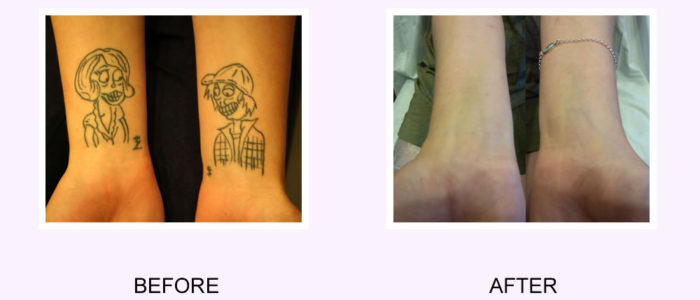 i want my tattoo removed i regret my tattoo i want my tattoo removed i regret my tattoo