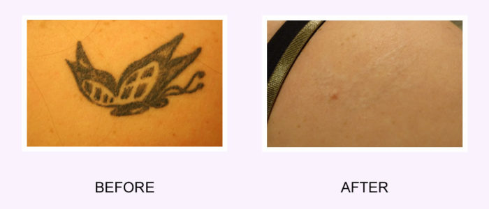 i want my tattoo removed i regret my tattoo i want my tattoo removed i regret my tattoo