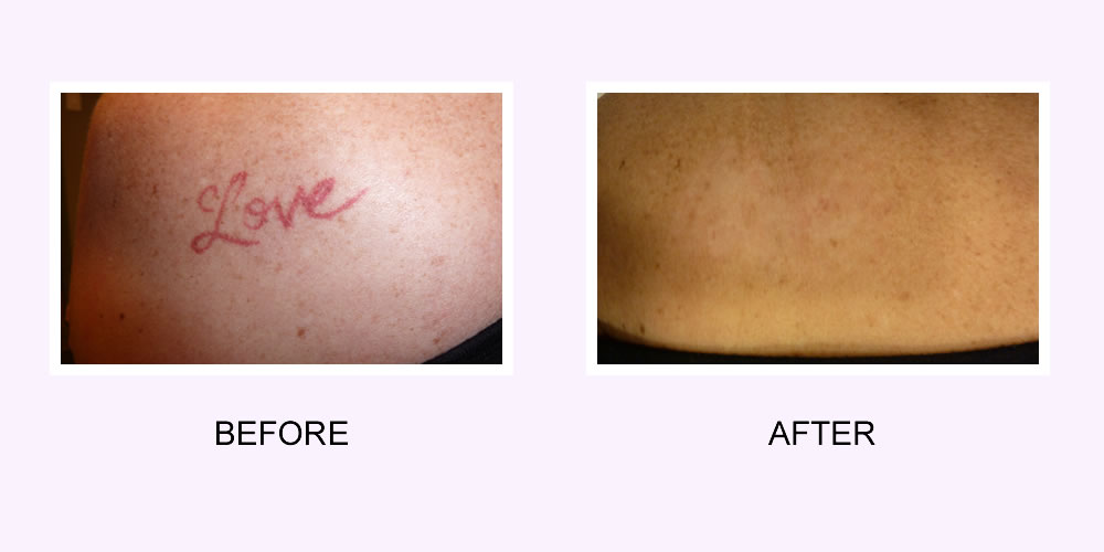 Laser Tattoo Removal Or Tattoo Removal Cream: Which One Is Better?