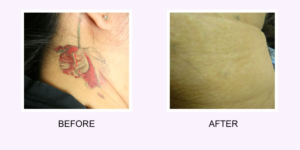 Specialist Clinic  Tattoo removal is the process of the removal of  unwanted tattoo on your body by means of a LASER treatment The main  benefits of laser tattoo removal are as
