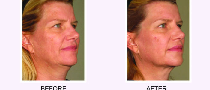 Non-invasive Neck, Chin, & Brow Lift with Ultherapy