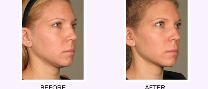 Non Invasive Neck Chin Brow Lift With Ultherapy